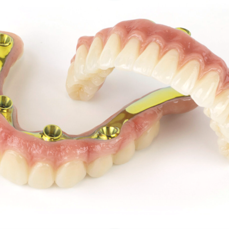 All-on-X Implant Rehabilitation
