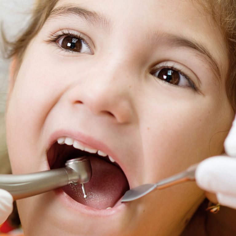 Baby-Tooth-Extraction3