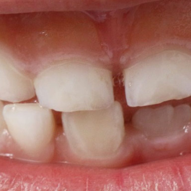 Baby-Tooth-Extraction9