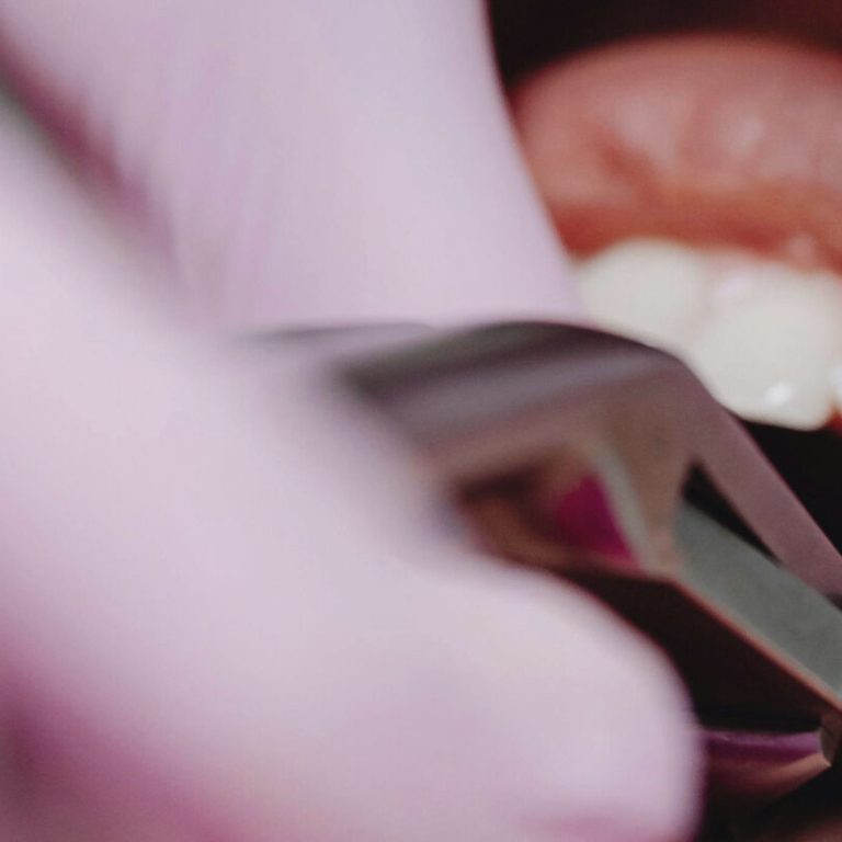 Wisdom-Tooth-Extraction5